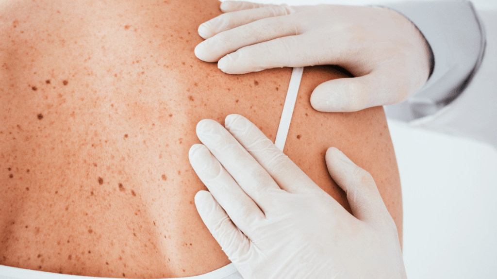 3 pasos que no fallan a la hora de evaluar tus lunares en&nbsp;casa